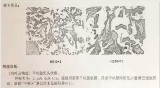 別慌，甲狀腺疾病還可以這樣投保！