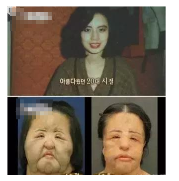 整容發(fā)生意外保險賠嗎？